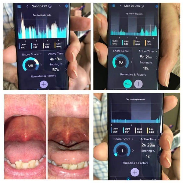 Laser snoring reduction